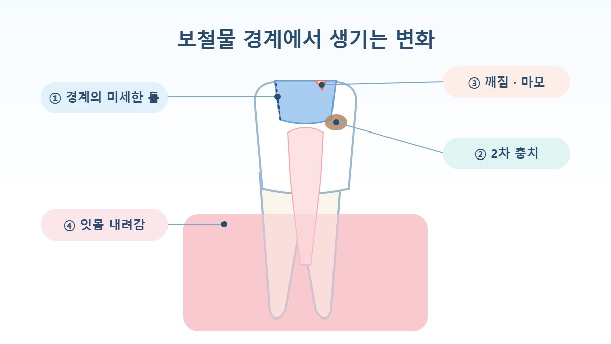 가락동치과 칼럼 - 수복물 경계의 틈, 2차 충치, 깨짐과 마모, 잇몸 내려감을 표시한 치아 단면 일러스트